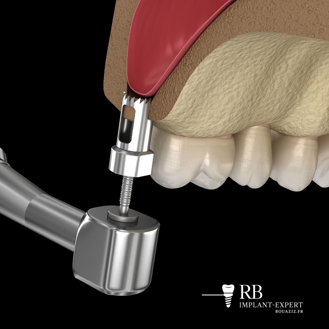 Sinus lift